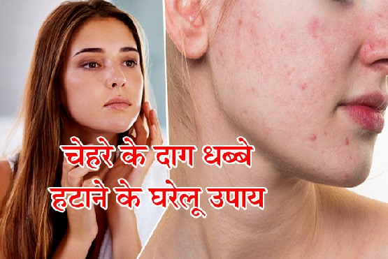 चेहरे से दाग-धब्बें हो जाएंगे छूमंतर... अपनाएं ये आसान घरेलू उपाय